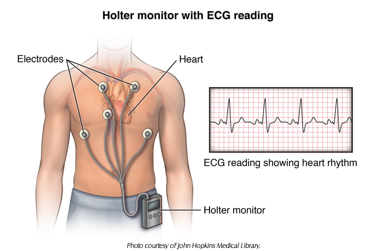 Holter heart rate monitor illustration